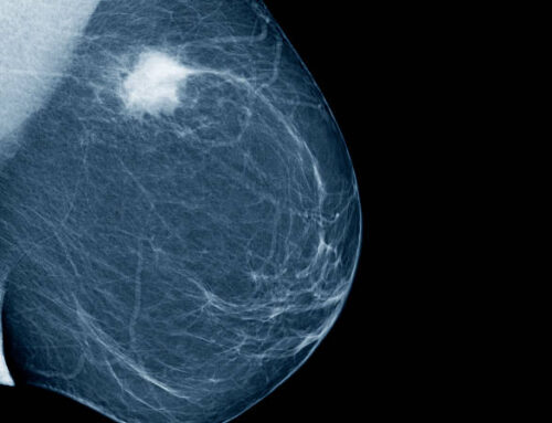 Mammograms: Top reasons you might be avoiding them